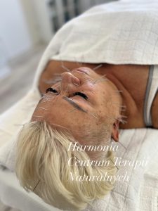 Akupunktura kosmetologiczna5